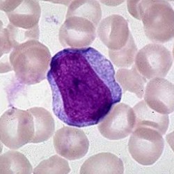 mijeloblast-leukemija.jpg mijeloblast-leukemija.jpg