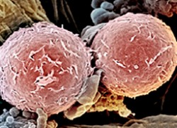 Leukemija-v.jpg Leukemija-v.jpg