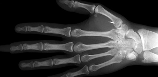 Implant-box.jpg Implant-box.jpg
