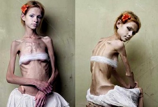 Anoreksija-tex1.jpg