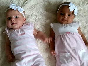 Близнакиње рођене са различитом бојом коже!