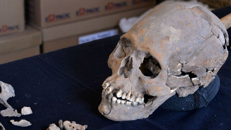 Вештачки зуб на деформисаној лобањи старој 1.600 година!