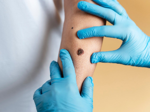 Регионални скуп о меланому: Србија још далеко од стандарда Европске уније