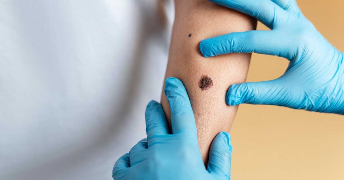 Регионални скуп о меланому: Србија још далеко од стандарда Европске уније