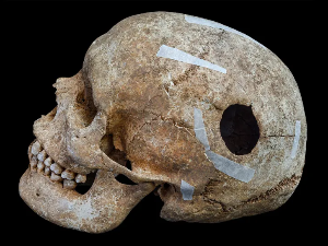 Загонетна гробница из викиншког доба – костури, лобање и остаци џина који је имао операцију мозга