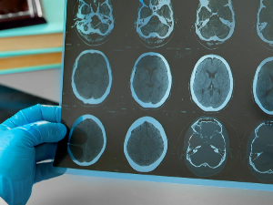 Разлике између вирусног и бактеријског менингитиса и када помаже вакцина