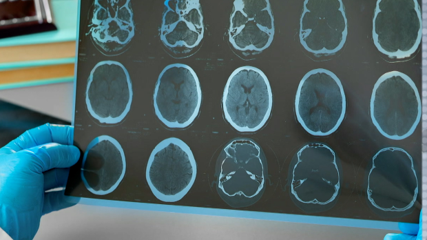 Разлике између вирусног и бактеријског менингитиса и када помаже вакцина