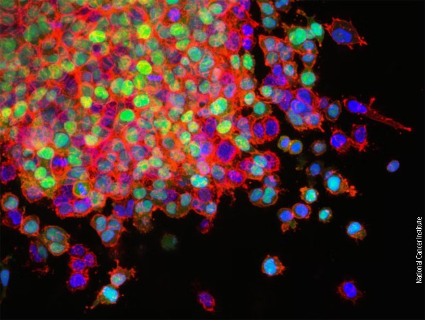 Metastatske ćelije raka grla