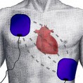 Дефибрилатор с поткожним електродама