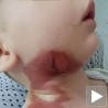 Одакле опекотине на дечаку леченом у Тиршовој
