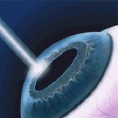 Светске новине у хирургији катаракте на ВМА