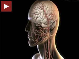 Српски лекари први пут у анеуризму уградили стент