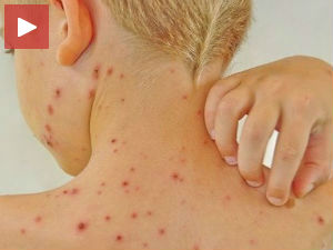 Епидемија малих богиња у Нишу