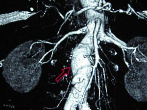 Рана дијагноза анеуризматске болести спасава живот