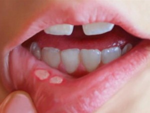 Родитељи забринути – шта је БРНУ вирус који се појавио у вртићима