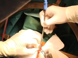 Први пут у Србији урађен захват дубоке мождане стимулације – електродом против Паркинсонове болести