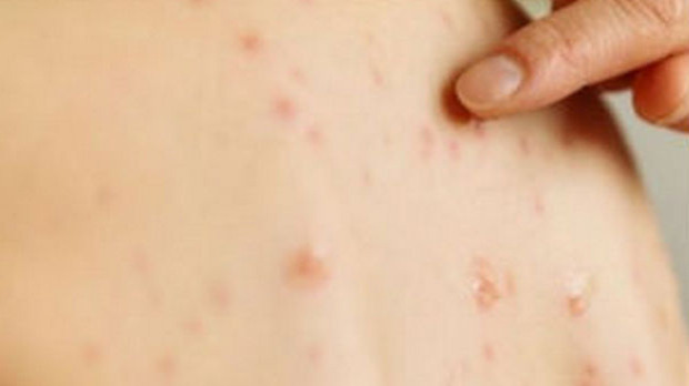 Прети ли нам епидемија морбила?