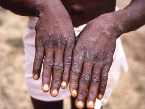 Шеклер: Нема разлога за панику, мајмунске богиње се не преносе лако