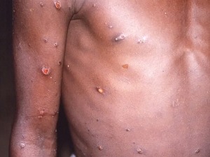 Како се преносе мајмунске богиње и штити ли вакцина против вариоле вере