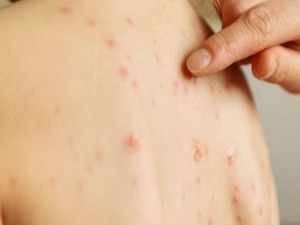 Институт "Батут":  Због малих богиња пооштрене мере епидемиолошког надзора