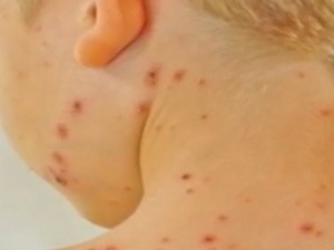 Батут, СЗО и Уницеф: Апел родитељима да вакцинишу децу против малих богиња