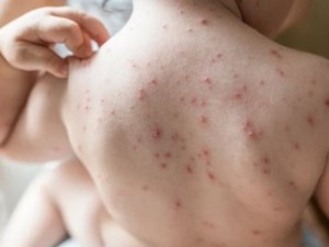 Батут: Мале богиње потврђене код 11 особа на територији Смедерева