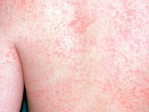 Нови случај малих богиња регистрован у Новом Саду, укупно 25 оболелих у Србији